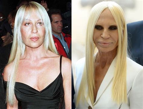 versace donatella|Donatella Versace before and after surgery.